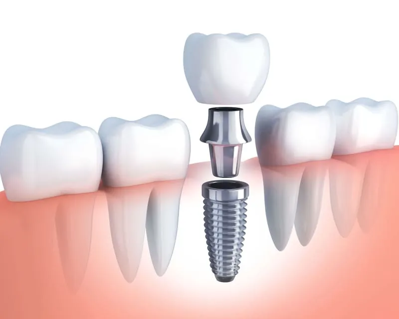Single Tooth Implants